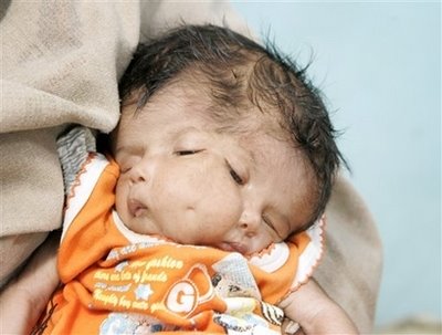 [Baby+born+with+2+faces+in+India.jpg]