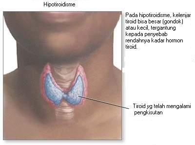 [hipotiroidisme.jpg]