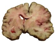 [180px-MCA-Stroke-Brain-Human-2.JPG]
