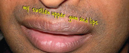 [swollen-lips-web.gif]