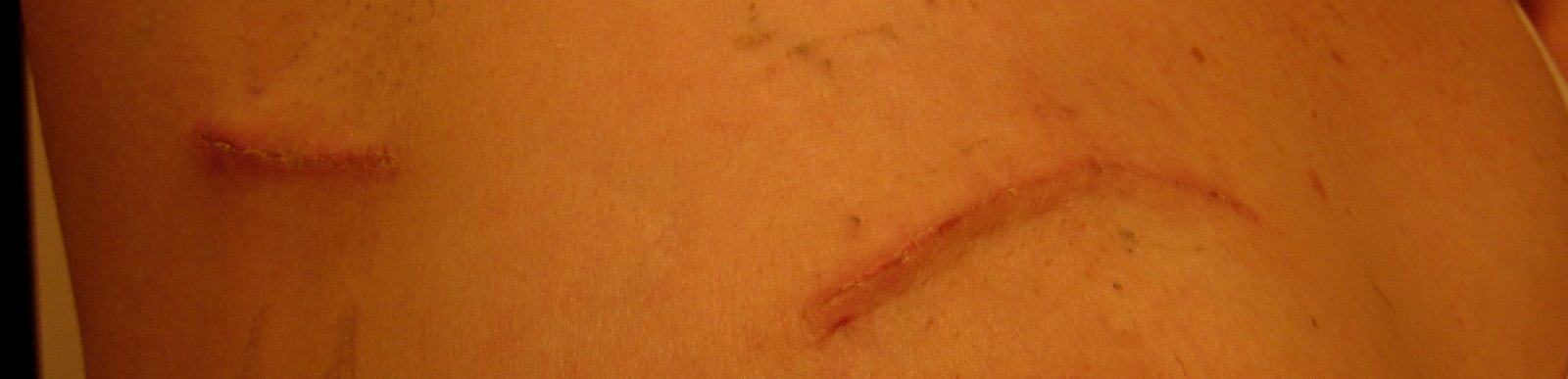 [Scars+One+Week+After+Surgery.jpg]