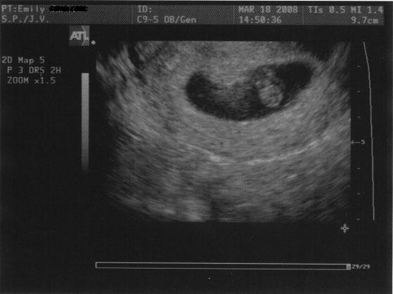 [Blog+First+Ultrasound+2.JPG]