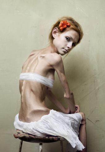 [bulimia-anorexia.jpg]