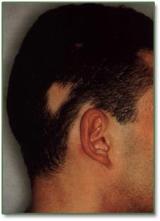 [alopecia-areata-1.jpg]