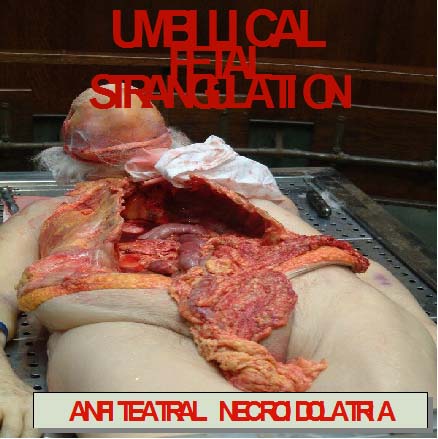 [Umbilical+Fetal+Strangulation+-+Necroidolatria2.jpg]