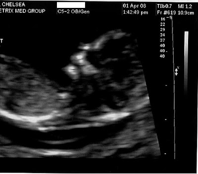 Healthy+heartbeat+at+6+weeks