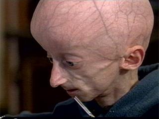 [progeria2.jpg]