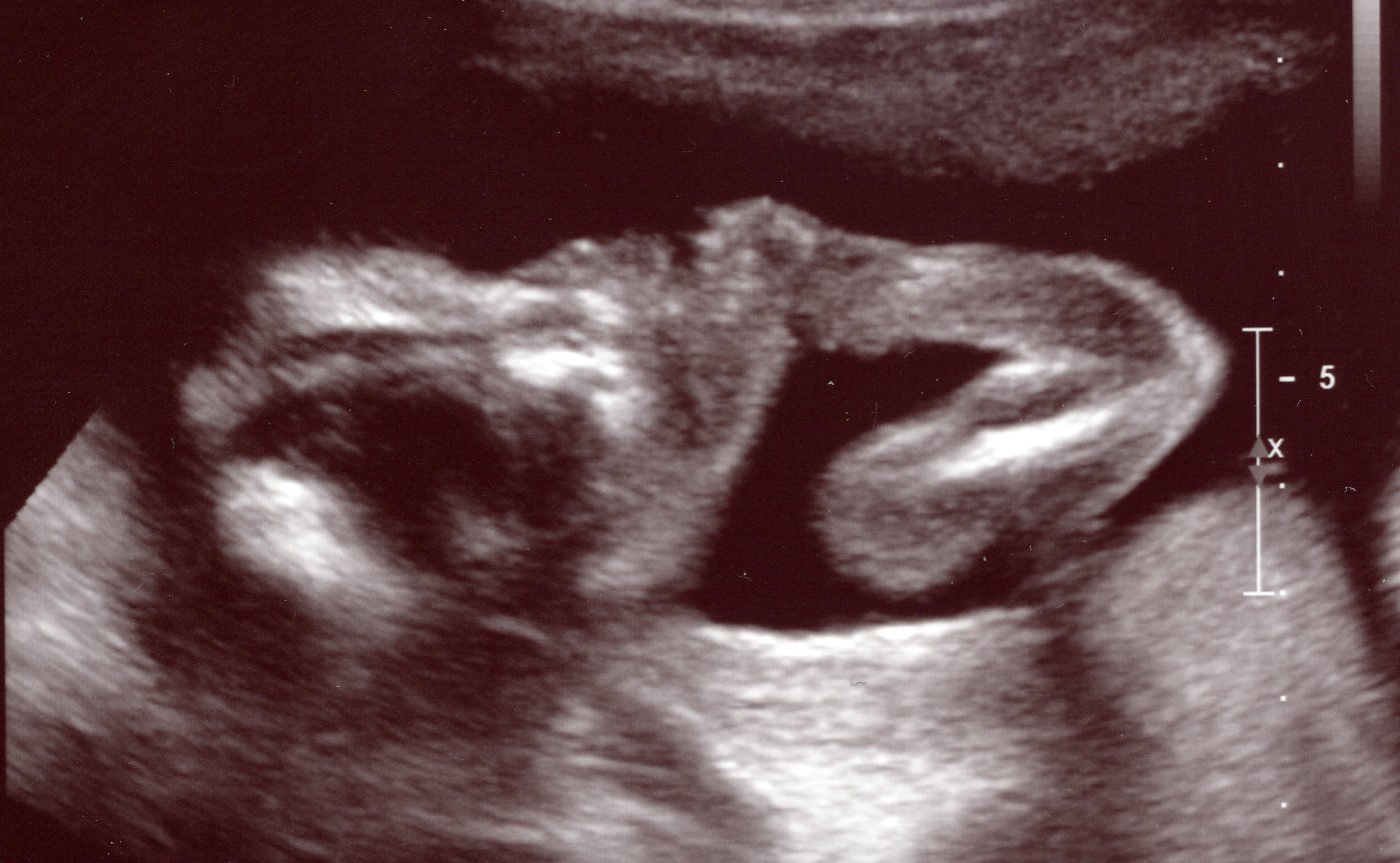 [Baby+ultrasound2.jpg]