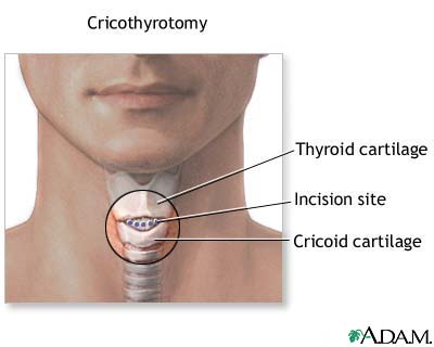 [cricoidotomy.jpg]