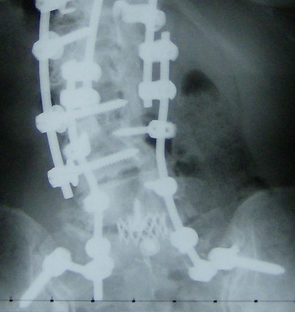 close up of lower back x-ray: nuts and bolts
