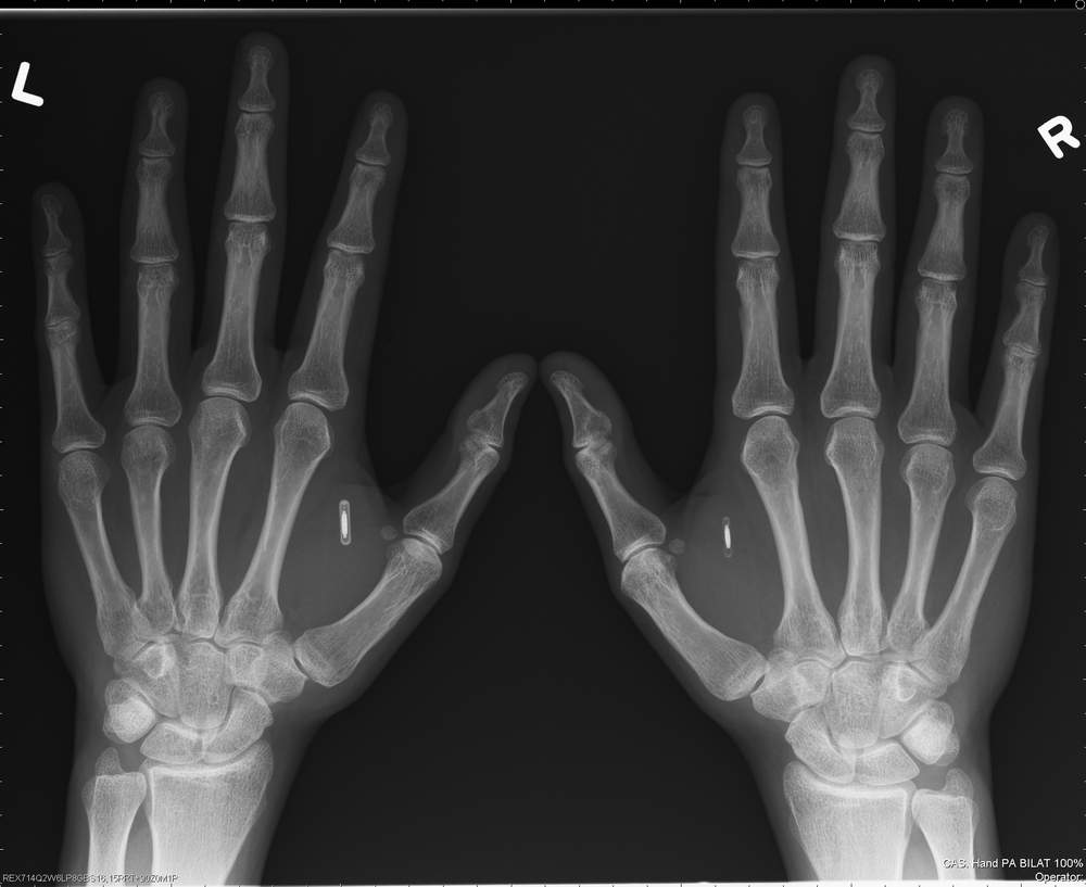 [x-ray+of+chipped+hands2.JPG]