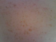 [freckle.jpg]