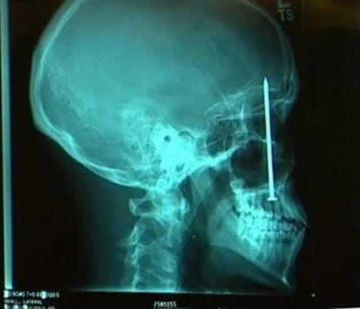crazy x-ray