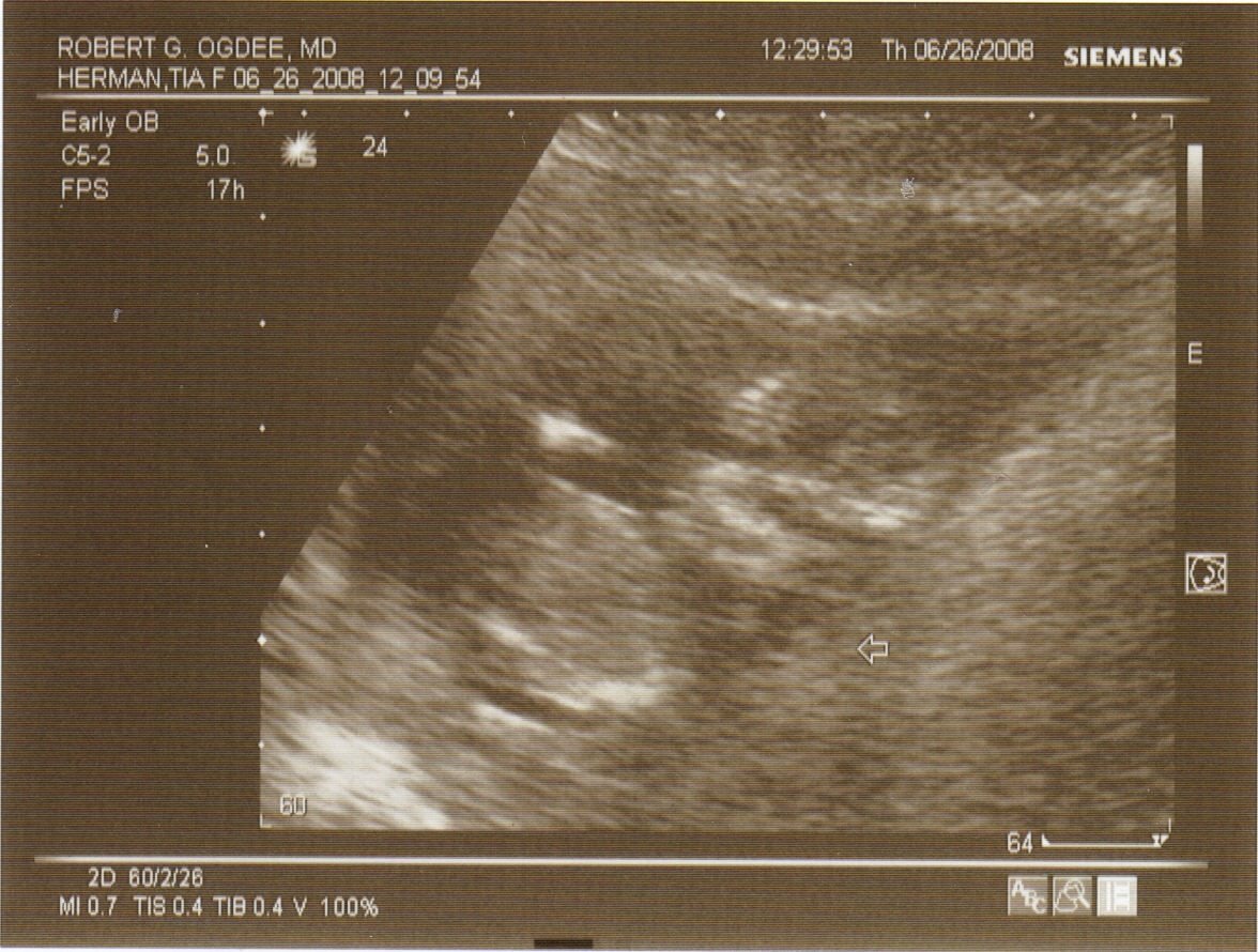 [ultrasound+13+weeks!.jpg]