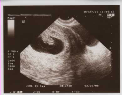 [Baby3-Second-Ultrasound.jpg]