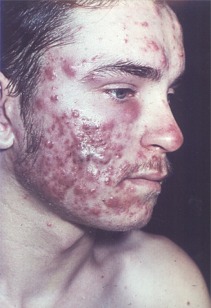 [acne-4.jpg]