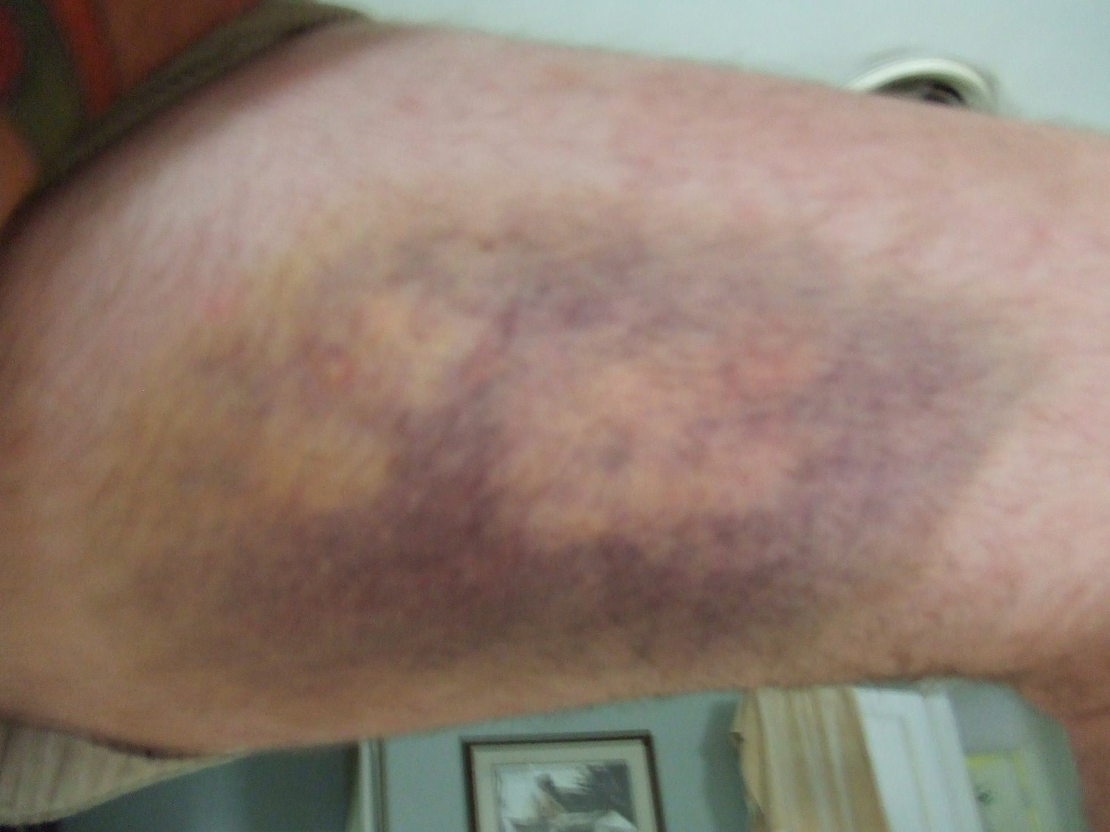 [bruise+day4.2.JPG]