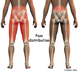 Arthritis Pain