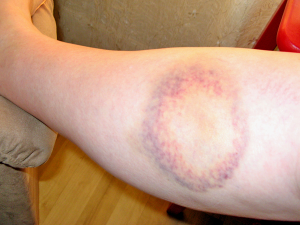 [0731-bruise.jpg]
