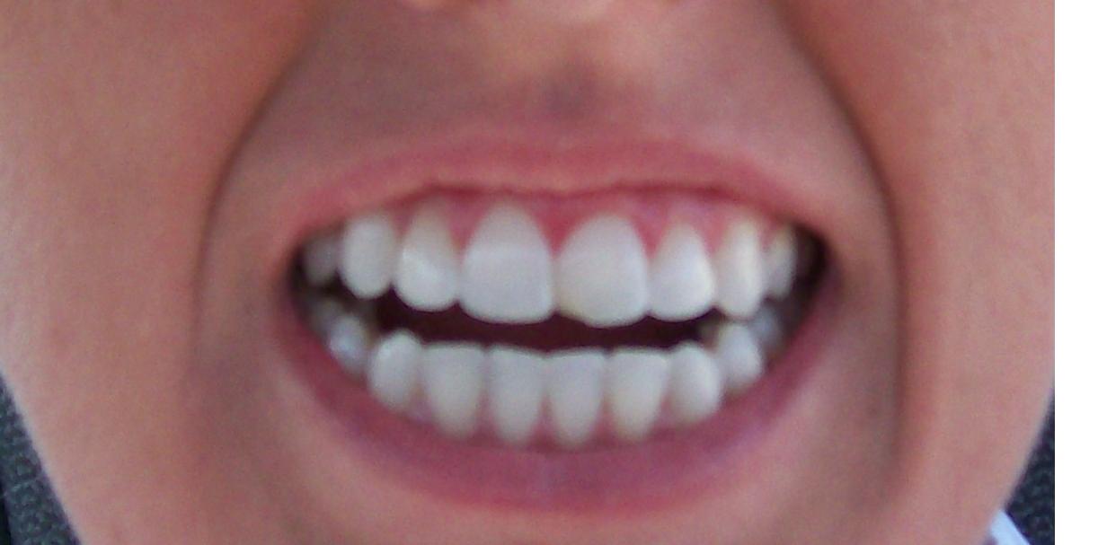 [teeth_before_zoom.JPG]