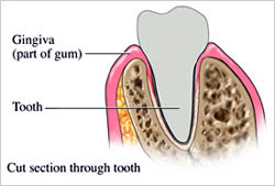 gum-diseases