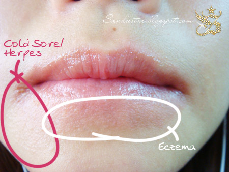 Symptoms+of+herpes+on+lips