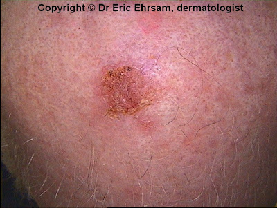 squamous cell carcinoma scalp dermoscopy