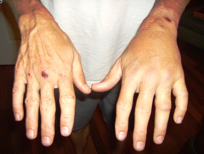 [wreck-07-20-08-swollen+left+hand.JPG]