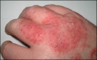 [190px-Dermatitis.jpg]