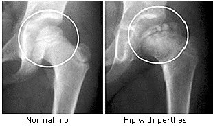 X-Ray example of Perthes Disease