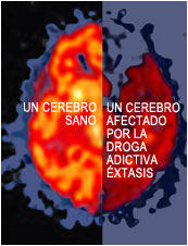 [cerebro+y+ectasis.jpg]