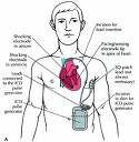 [cardioverter_defibrillators2.jpg]