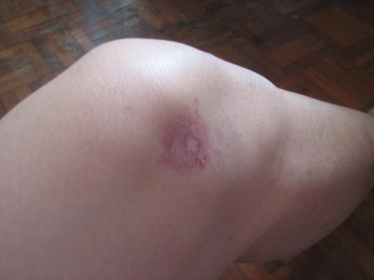 [bruise1.JPG]