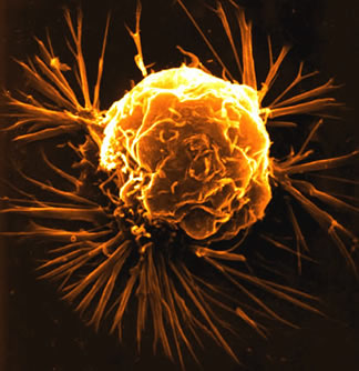 [breast cancer cell.jpg]