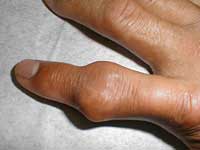 [arthritis-knuckle-gout.jpg]
