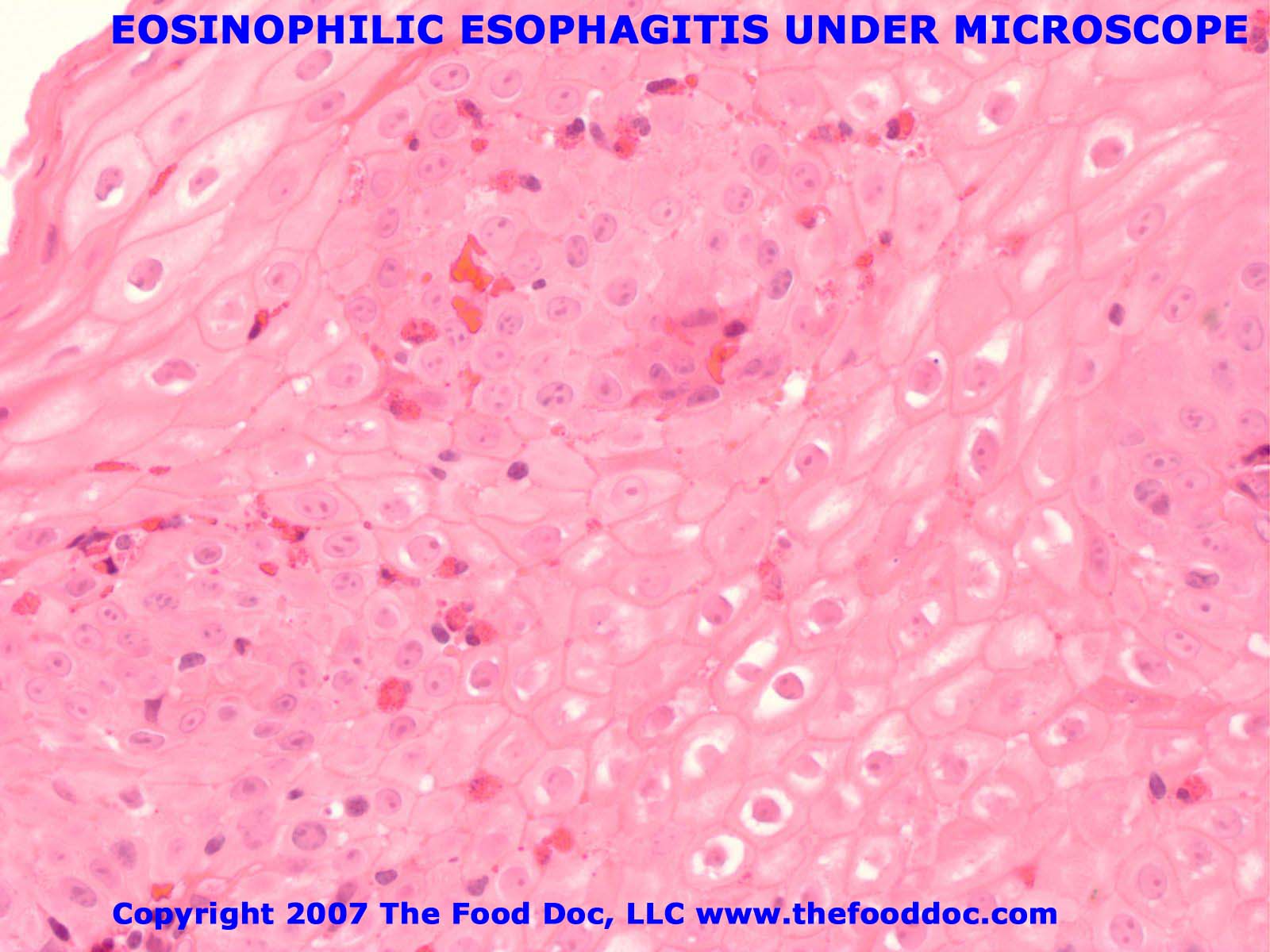 [Eosinophilic+Esophagitis+MICROSCOPE+SLIDE.jpg]
