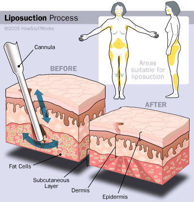 [liposuction-process.gif]