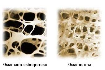 [osteoporose.jpg]