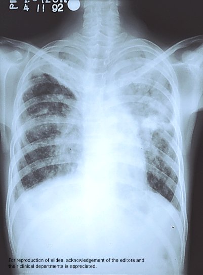 [Tuberculosis1.jpg]