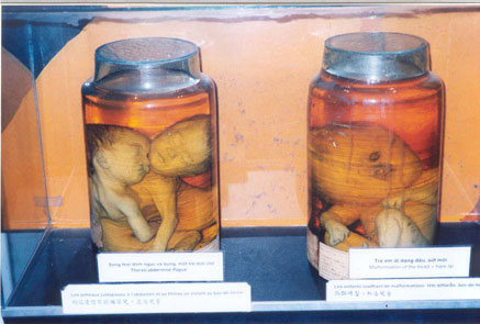 [Fetuses+of+victims+of+dioxin,+from+Agent+Orange..jpg]