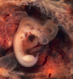 [250px-Tubal_Pregnancy_with_embryo.jpg]