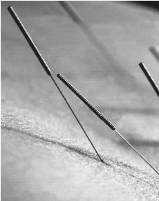 [acupuncture.jpg]