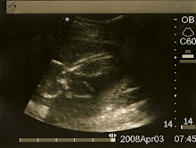 Baby Girl - 17 Weeks