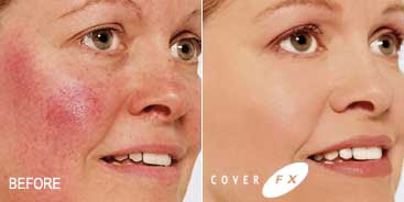 before and after pictures of a woman using Cover FX Total Coverage Cream Foundation